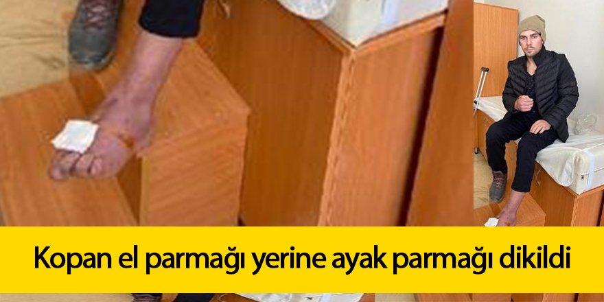 Kopan el parmağı yerine ayak parmağı dikildi